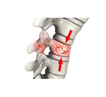 spinal trauma surgery procedure
