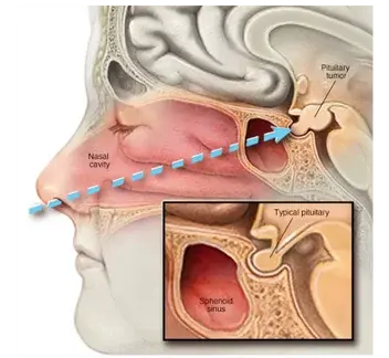 Endoscopic Pituitary Macroadenoma Excision Surgery