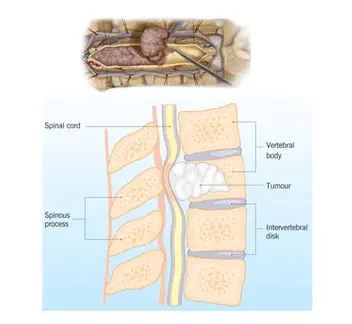 spinal tumor surgery