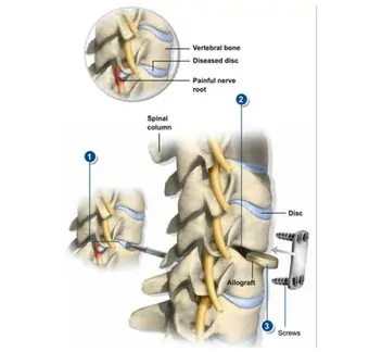 surgery for slip disc