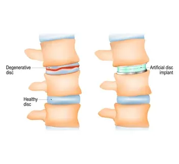 disc replacement surgery