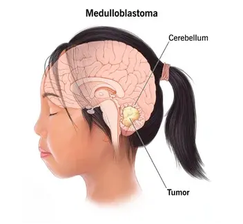 Medulloblastomas