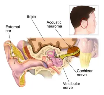 Schwannomas (Acoustic Neuromas)