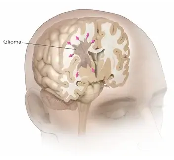 brain tumor surgery